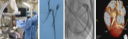 Evaluation of stent and<br>catheter of cardiovascular tolerance